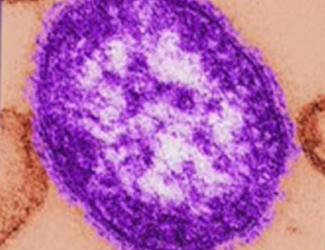 Measles Confirmed Arizona